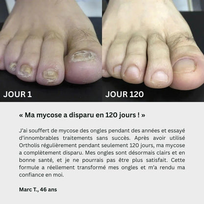 Gel contre les mycoses des ongles Ortholis