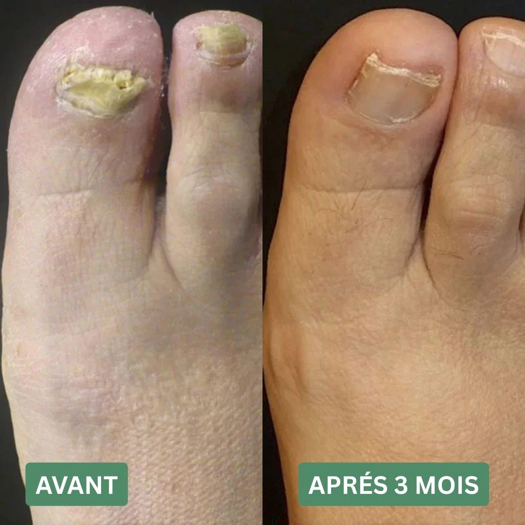 Gel contre les mycoses des ongles Ortholis