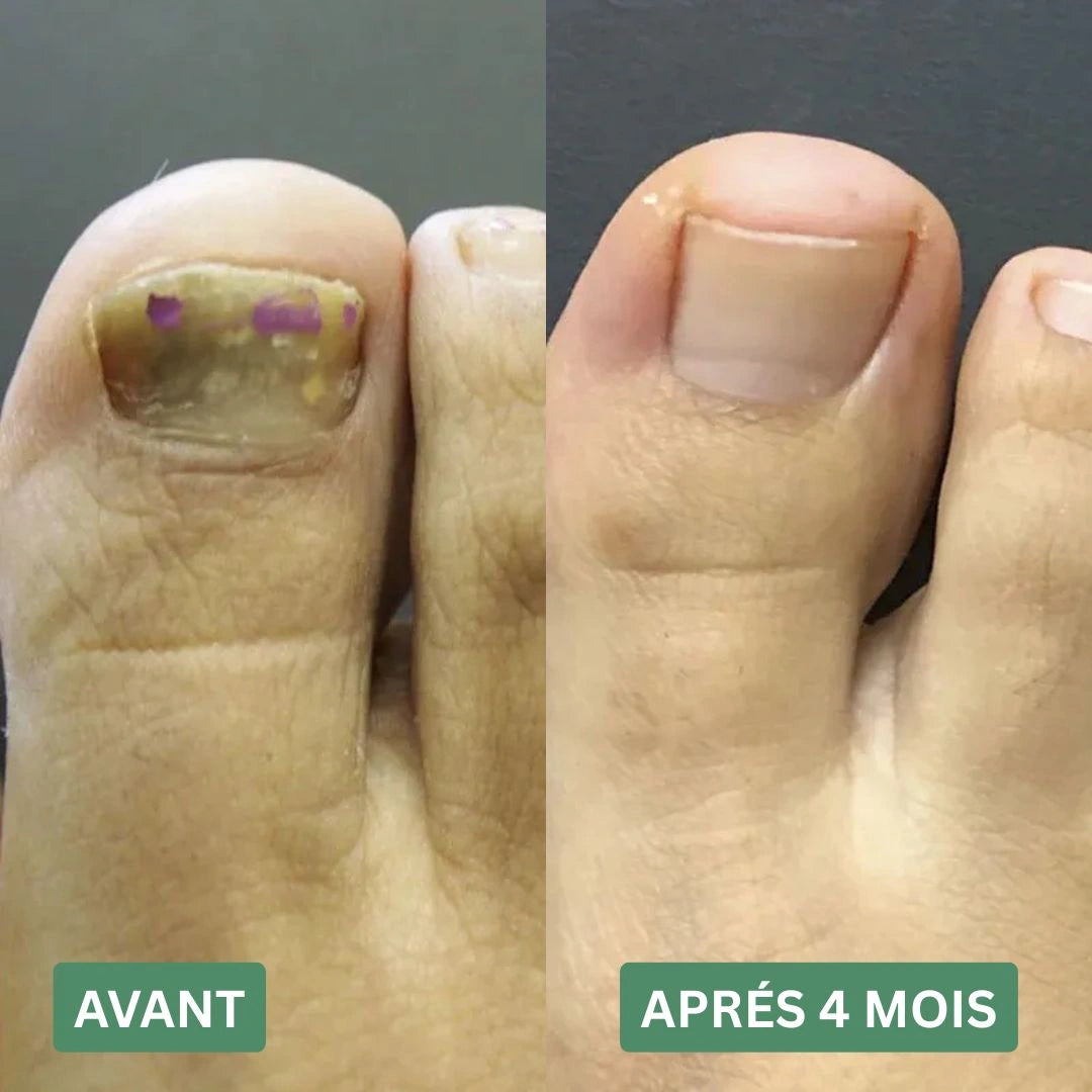 Gel contre les mycoses des ongles Ortholis